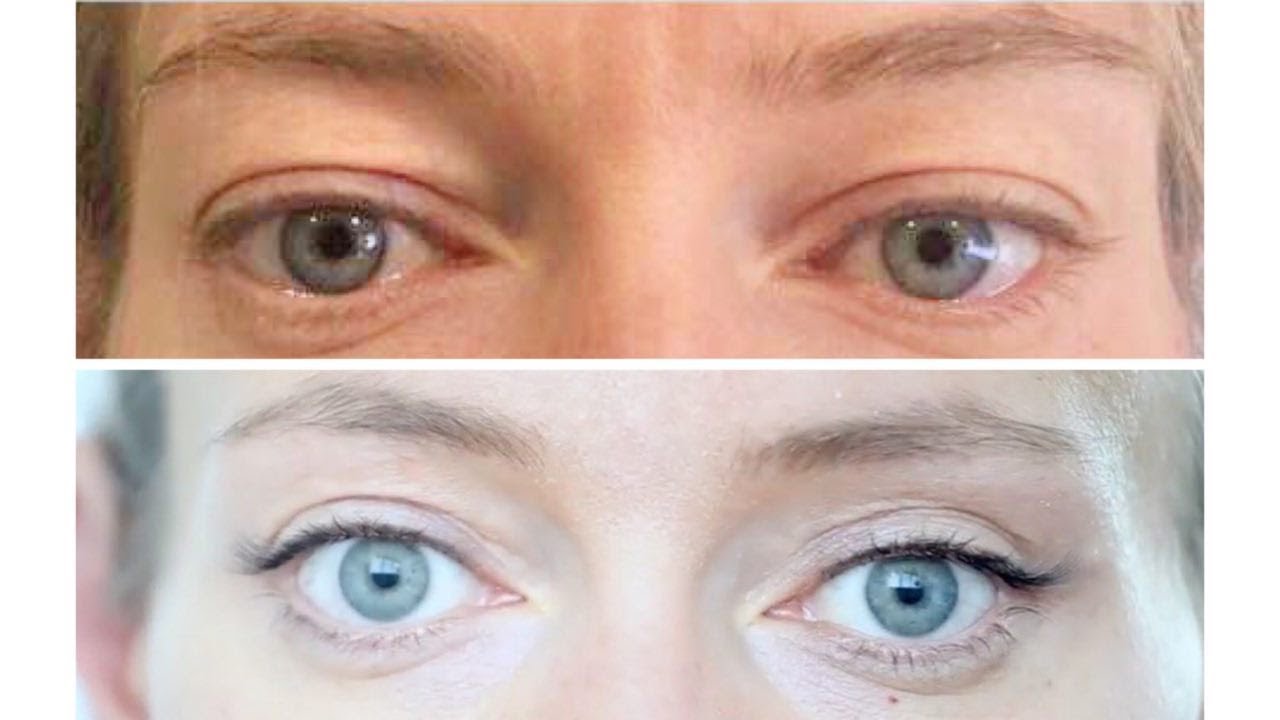 Пластическая хирургия: до и после. #Блефаропластика. Мой опыт.