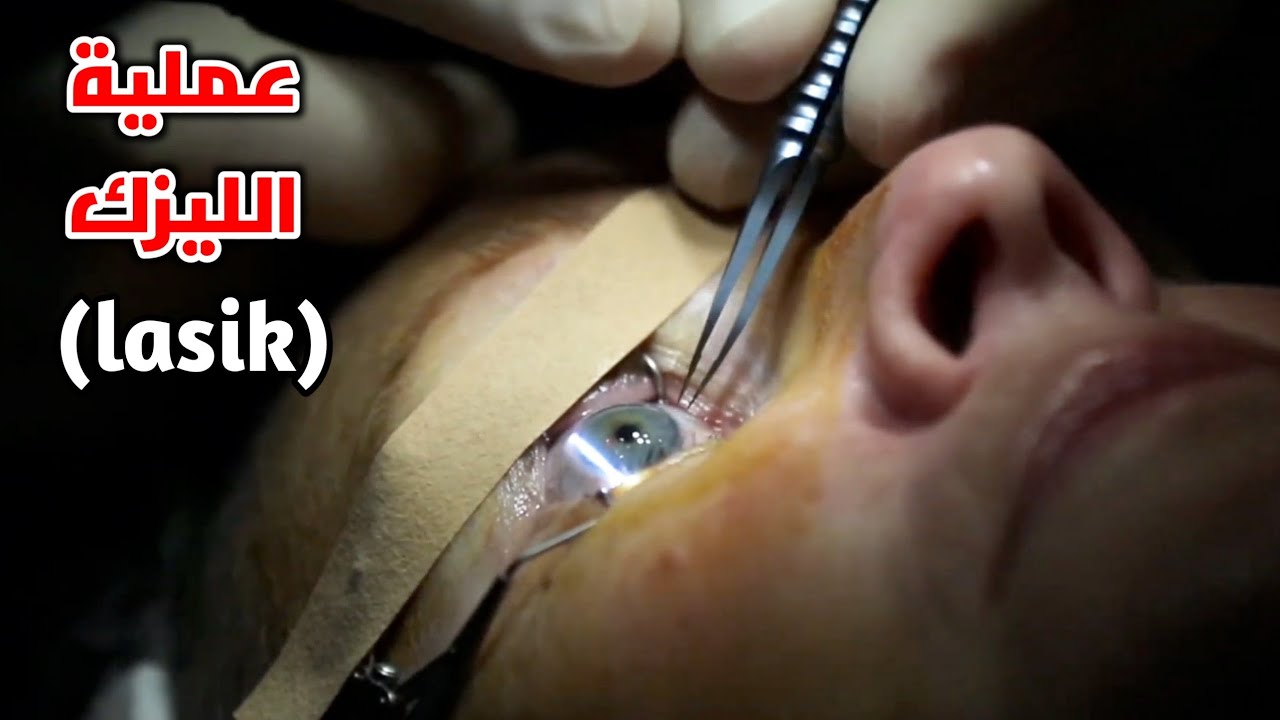 شاهد عملية تصحيح النظر بالليزر(عملية الليزك)_laser eye surgery(lasik)
