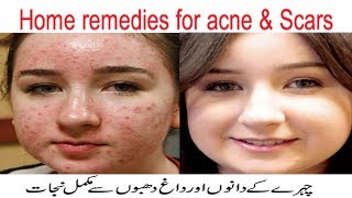 How to Get Rid of Acne Scars Fast, Best Acne Scar Treatment, Overnight Home Remedies for Acne Scars