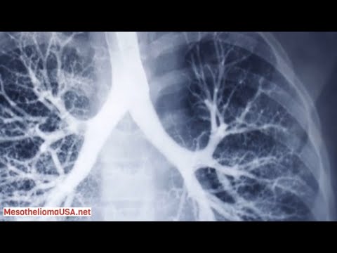 Video: Haploinsufficiency BAP1 Memprediksi Kelas Imunogenik Yang Berbeda Dari Mesotelioma Peritoneum Ganas