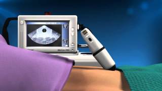 Cubescan BioCon-700 Bladder Scanner - Reduce Urinary Tract Infections (UTI)