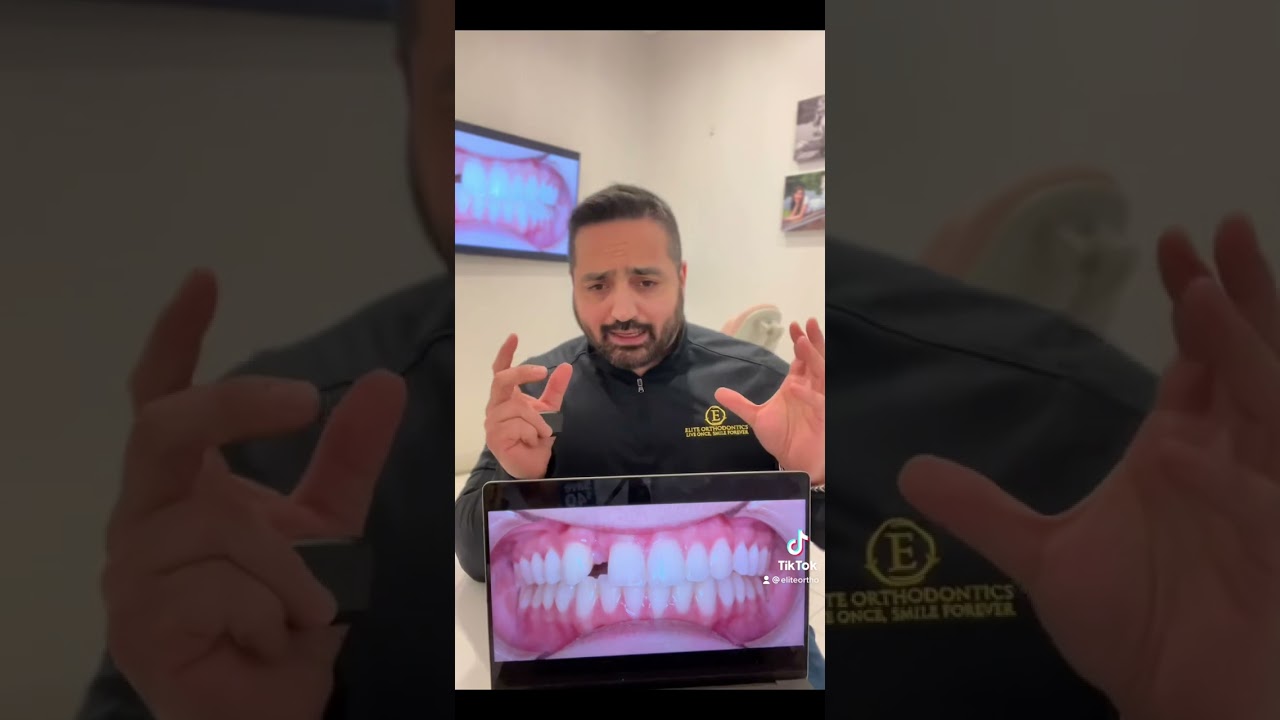 Canine substitution for missing lateral incisor