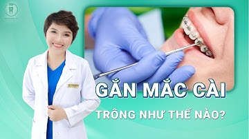 Gắn Mắc Cài Niềng Răng Trông Như Thế Nào | Bác sĩ Thoa Bình Dương