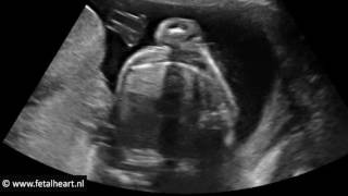 Download lagu Fetal heart Academy - Heterotaxy #1, full sweep stomach rightsided