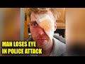 Man Who Lost Eye From BRUTAL Police Beating Gets $4 Million
