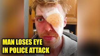 Man Who Lost Eye From BRUTAL Police Beating Gets $4 Million Content