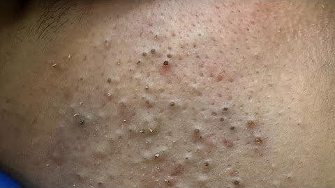 [ASMR] Deep Cleansing Techniques for Acne Treatment and Relaxation