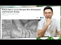 Virus Cacar Monyet, Ini yang Perlu Anda Ketahui