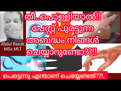 How to Heal a Burn Fast,തീ പൊള്ളിയാൽ പേസ്റ്റ് പുരട്ടാമോ?Health Tips, Abdul Rasak Easy English