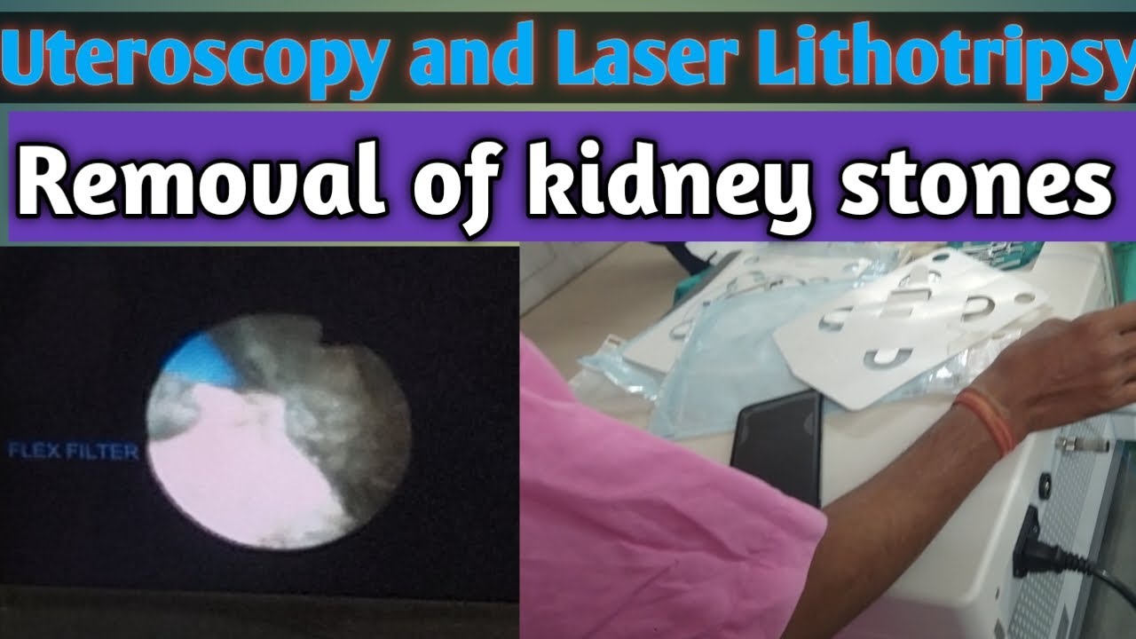 URS surgery with Holmium LaserRemoval of kidney stonesUteroscopy