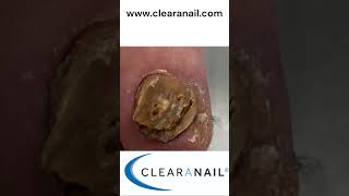 Fungal Nail Clearanail Treatment Fungal Face Goodbye