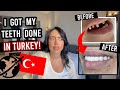 I GOT MY TEETH DONE IN TURKEY!