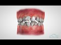 3D Animation showing teeth movements