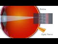 How does an artificial retina work?