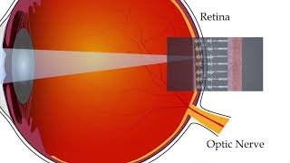 How does an artificial retina work?