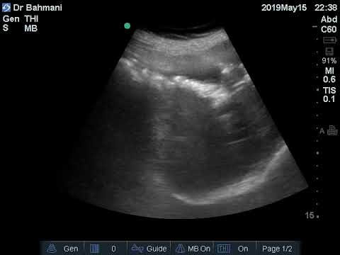 Case 175 : Gall Bladder Stones