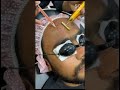 PRP Facelift (vampire facelift)  medi-facial ,prp facial  #skinrejuvination #prpfacial #medical