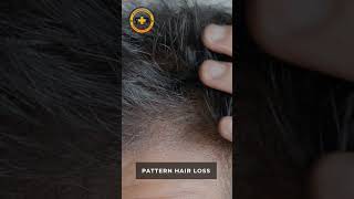 Before You Buy Another Hair Serum, Watch This! #hairloss #hairfalltreatment