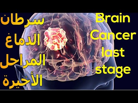 أعراض سرطان الدماغ فى مراحله الأخيرة | هل لديك إحداها ؟ | Brain Cancer Symptoms