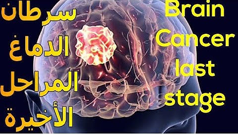 أعراض سرطان الدماغ فى مراحله الأخيرة | هل لديك إحداها ؟ | Brain Cancer Symptoms