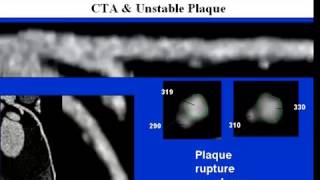 CCTA Training Lecture 7C Contrast CT Coronary Angiography