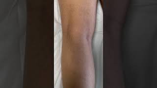 Stretch Marks Inkless Removal Boleyn Treatment Los Angeles  🌍 #shorts