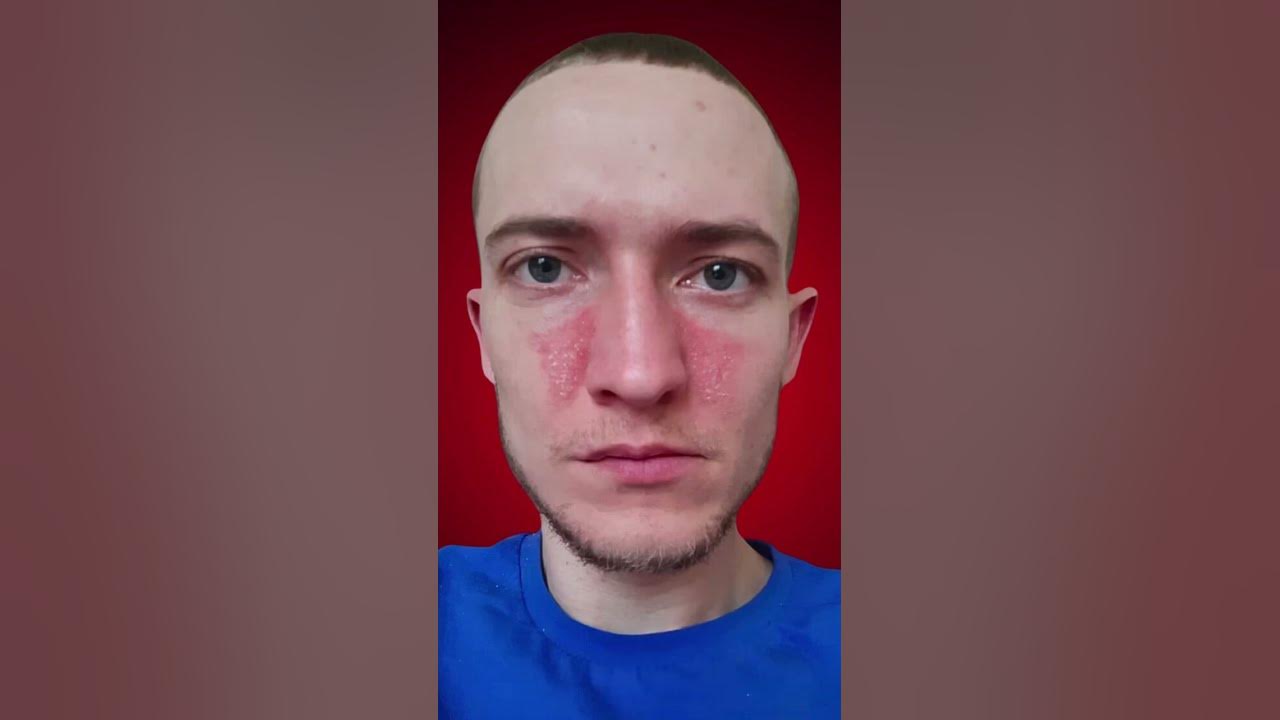 🆘БЫЛО/СТАЛО.СЕБОРЕЙНЫЙ ДЕРМАТИТ - проблемная кожа лица #лечениесебореи ...