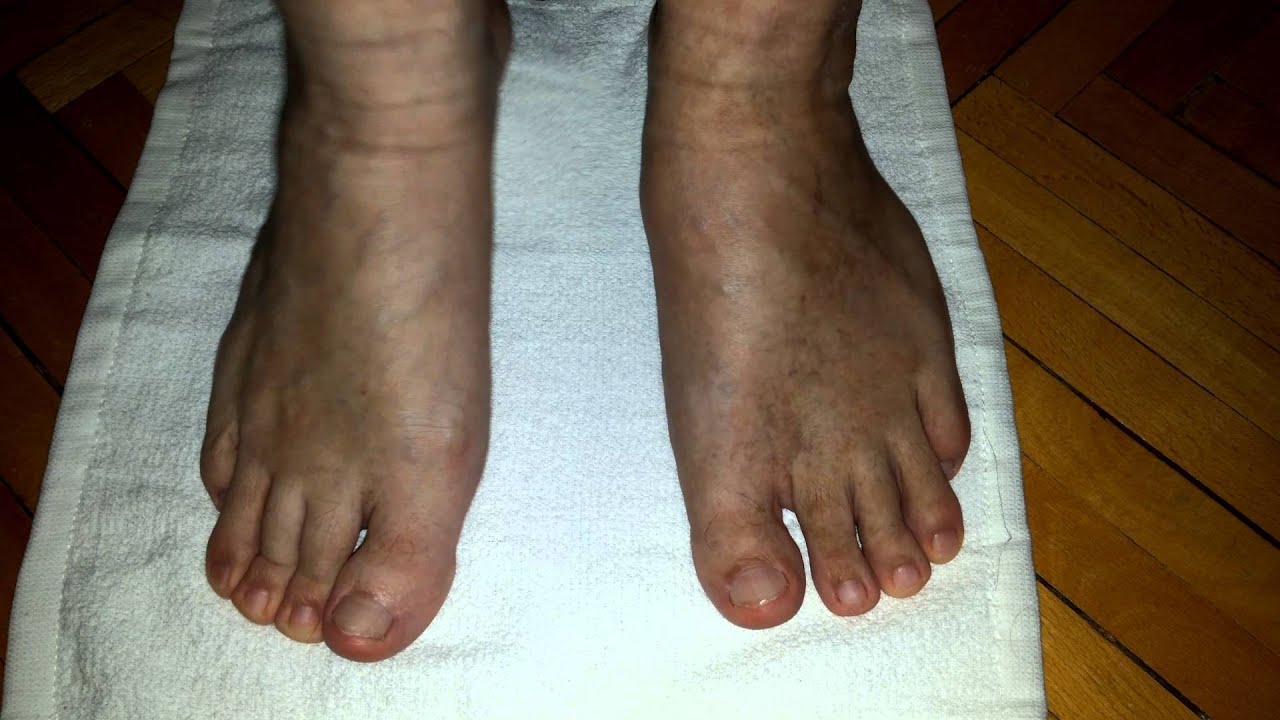 Растяжение связок голеностопного сустава - 3 - YouTube