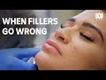 Lip fillers last waaaay longer than you think | Catalyst