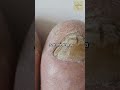 The Hidden Dangers of Nail Fungus—and Why You Need to Treat It Fast  #toenailfungustreatment