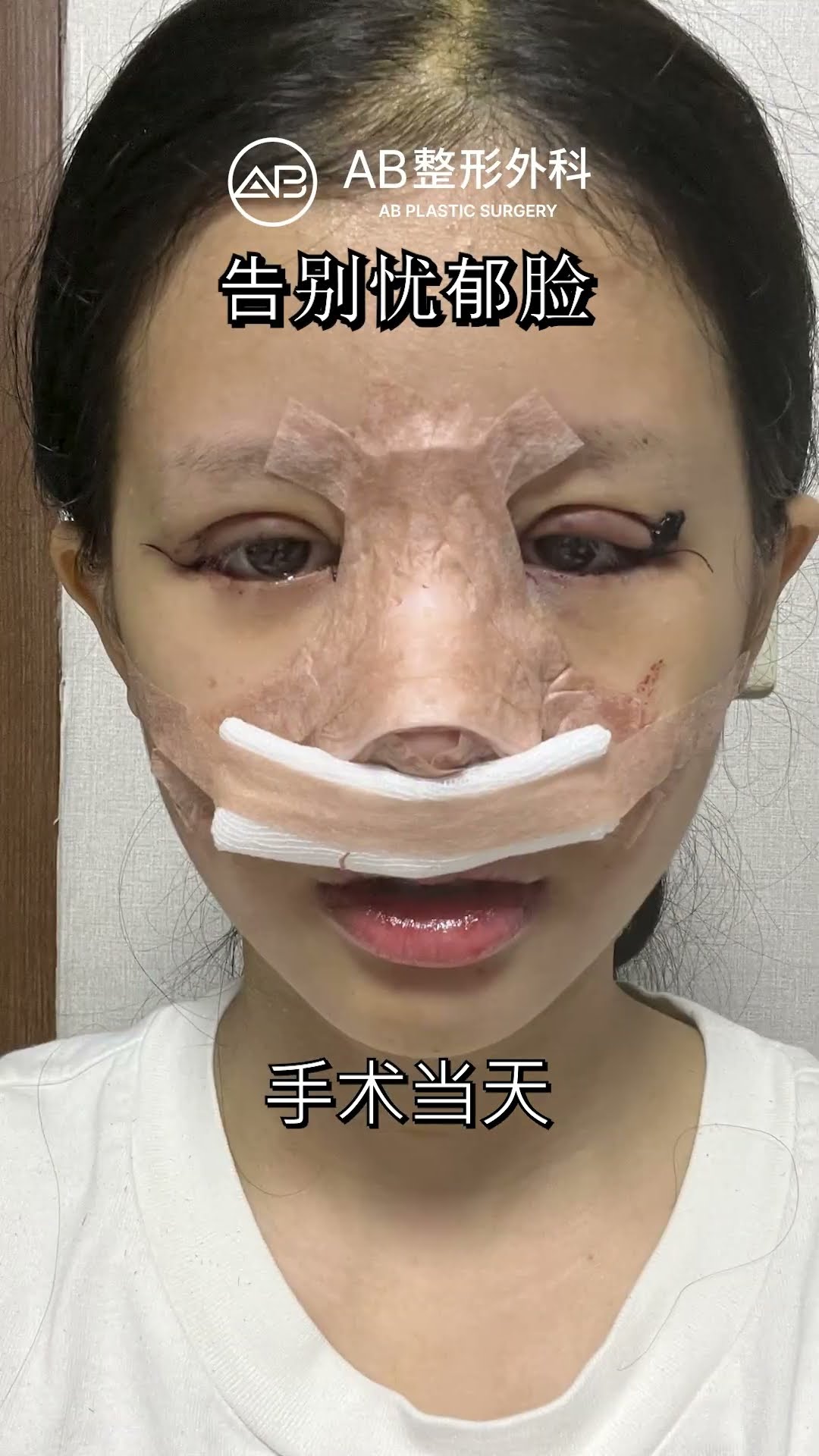 [整形心得] 眼睛重修 & 隆鼻手術 1個月，180度的大變身 #韓國整形 #shorts