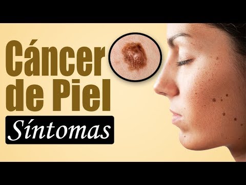CÁNCER DE PIEL: Síntomas, Tipos, Causas y Tratamiento (Melanoma)| SALUDABLEMENTE TV