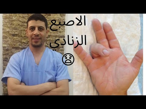 فيديو: كيفية علاج إصبع الزناد: 10 خطوات (بالصور)