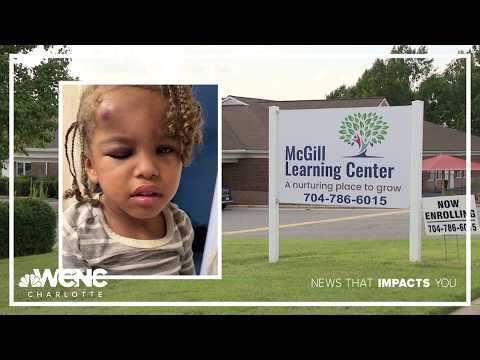 Concord daycare with state violations under microscope after toddler comes home with swollen face