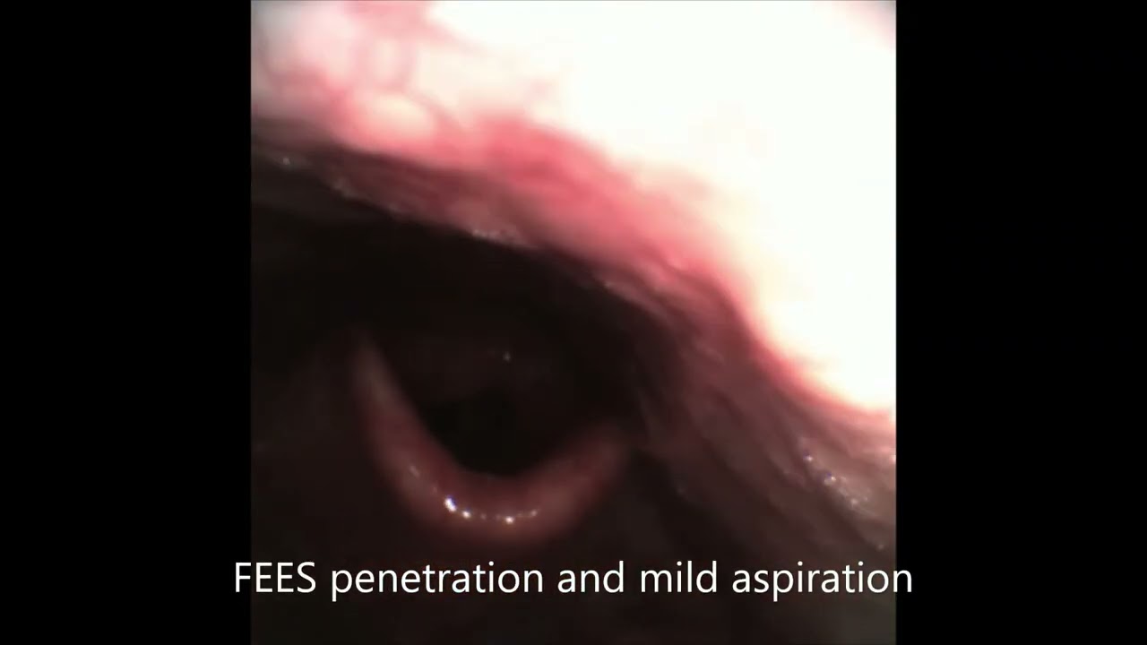 BVCP 1 year after Thyroidectomy