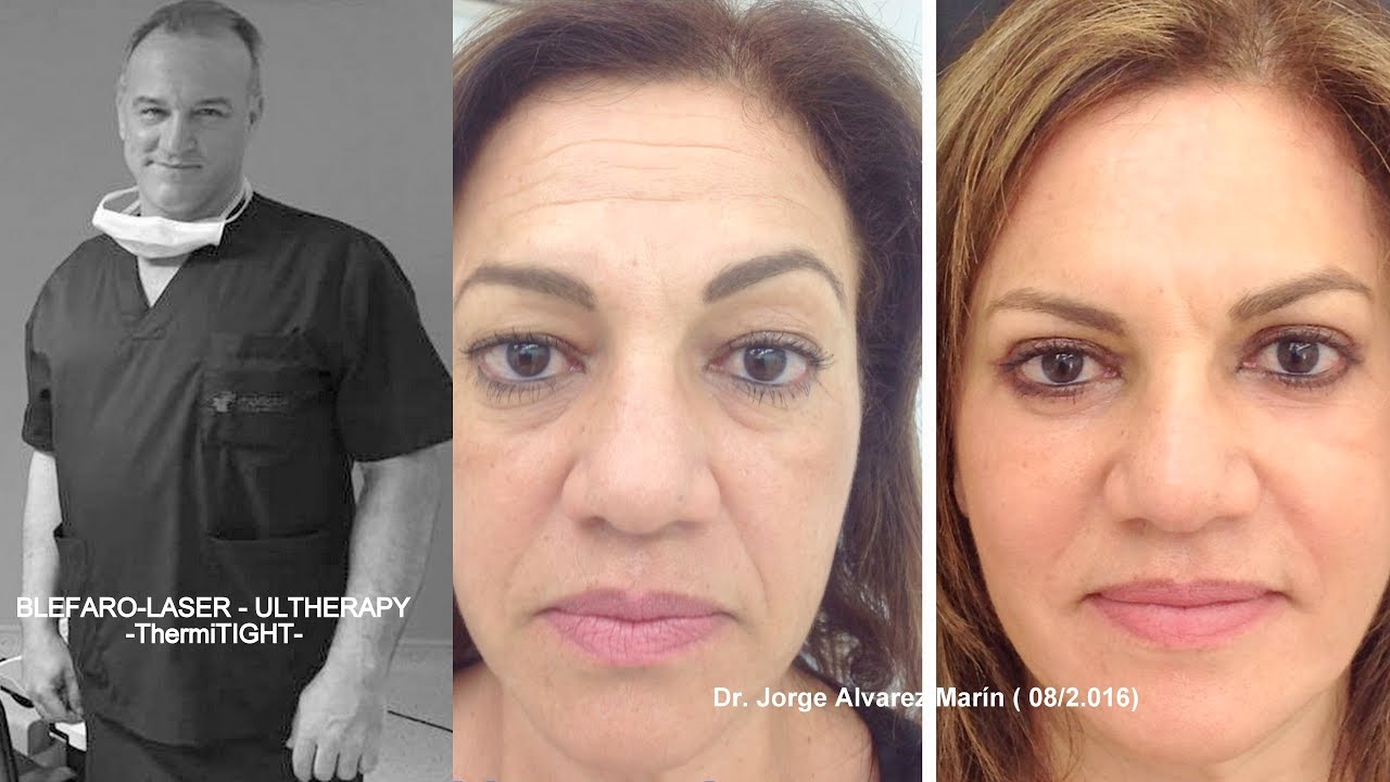 ULTHERAPY LIFTING FACIAL SIN CIRUGÍA NO INVASIVO (CANARIAS) camera iphone 8 plus apk