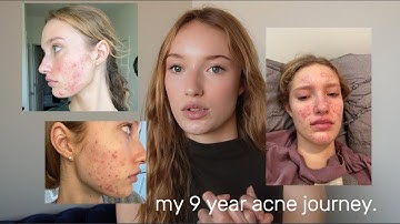 my 9 year acne journey.