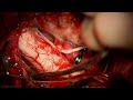 Far Lateral Craniotomy for Clip Reconstruction of a Fusiform V4 Vertebral Artery Aneurysm