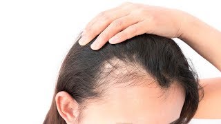 لأول مرة طرق معالجة الصلع و انبات الشعر بين فراغات الرأس أصبحت سهلة و في المنزل