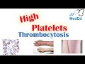 What Causes High Platelets (Thrombocytosis) | Approach to Causes, Symptoms, Treatment