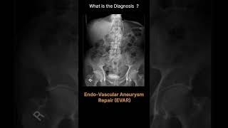 EVAR Abdominal X-ray - Artifacts - Endo-Vascular-Aneurysm-Repair - EVAR 103 #@radiologychannel007