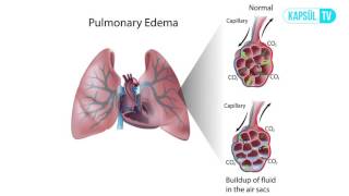 Akciğerde Sıvı Toplanması (Pulmoner Ödem) Nedir?