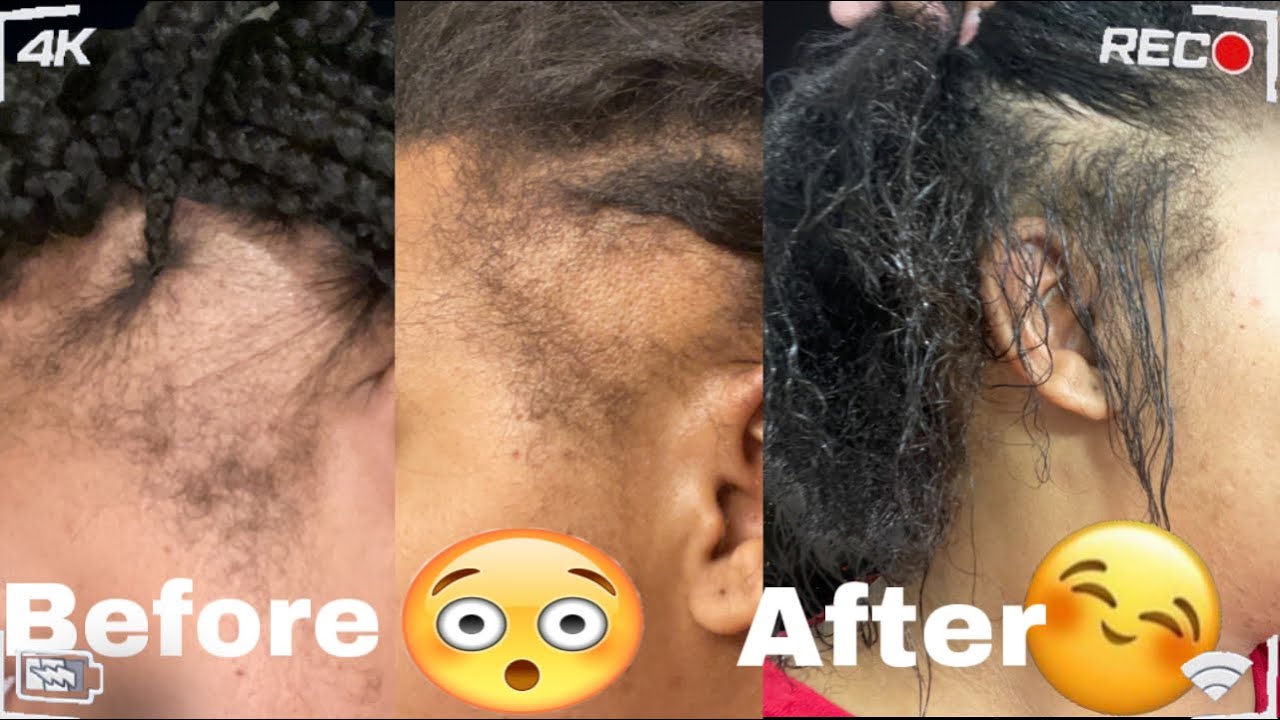 HOW I REGREW MY EDGES| TRACTION ALOPECIA