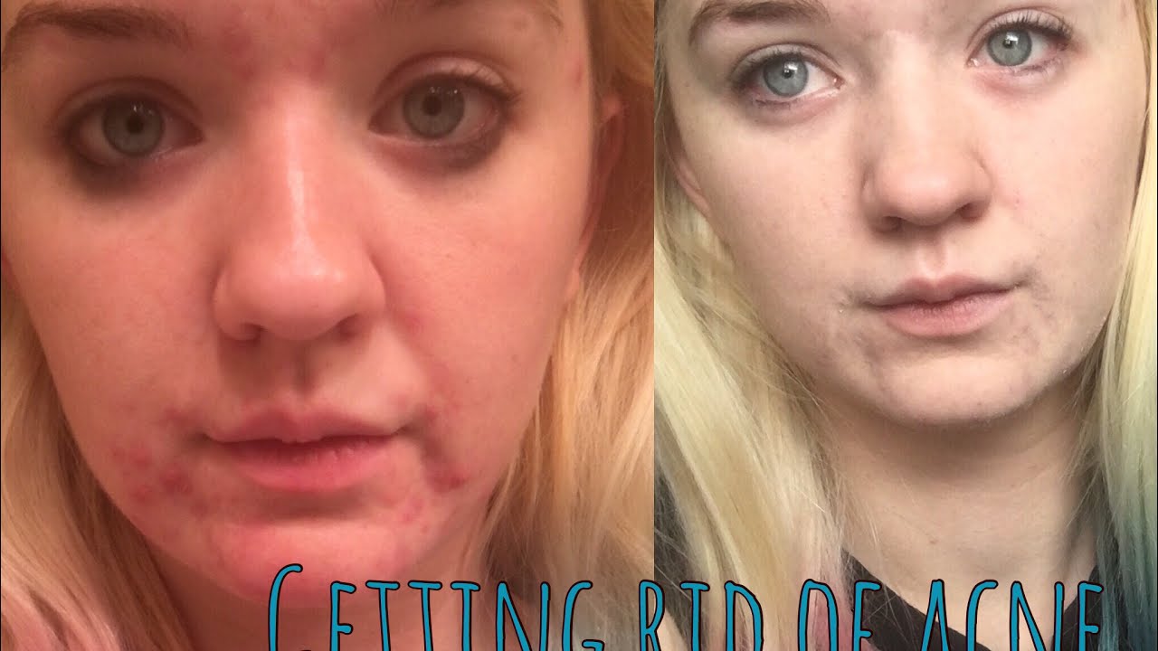 HOW I GOT RID OF MY ACNE - YouTube