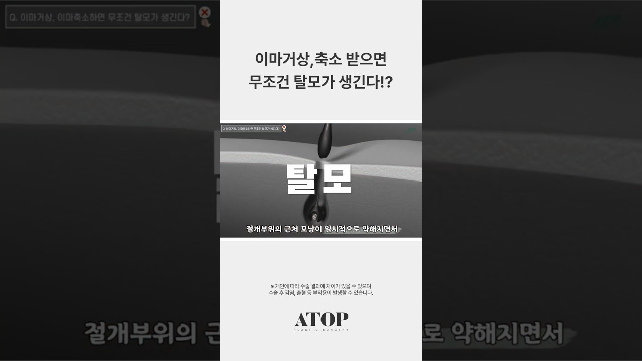 Эйтоп гоо сайхны мэс заслын эмнэлэг: Дух өргөх, багасгах мэс засал хийлгэвэл заавал үс унадаг уу!?