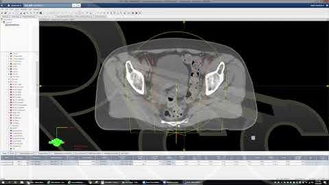 How to develop the PERFECT VMAT plan for Pelvic cases... on FIRST Attempt