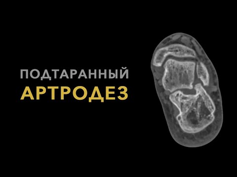 Видео: Что такое артродез подтаранного сустава?