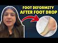Feedback: Foot Deformity After Foot Drop | #drchandannarang #footandanklesurgeon