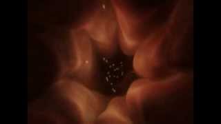 What Is Iui? What Is Iui Procedure?