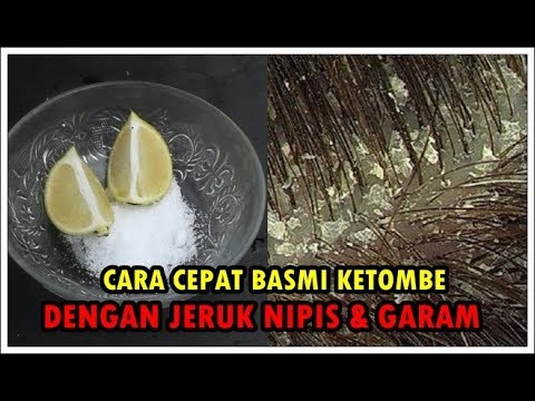 Cara Cepat Menghilangkan Ketombe Di Kepala Youtube